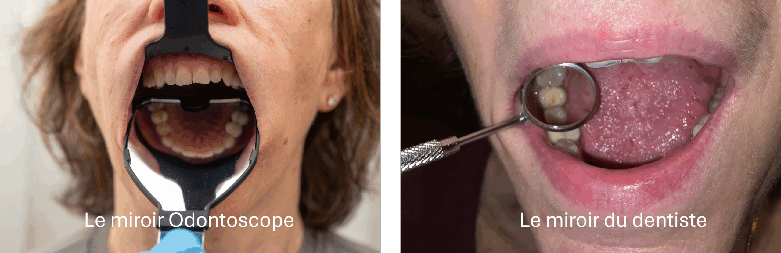 Comparaison de la surface visuel du miroir dentaire classique et du miroir Odontoscope.jpg Le miroir buccal classique : un outil très précis, mais pensé pour le cabinet dentaire Le miroir traditionnel fonctionne parfaitement lorsque le dentiste travaille en bouche avec une lumière puissante, une aspiration efficace et une coopération du patient. Il permet d’observer une dent, une muqueuse ou un détail précis, en orientant la lumière et en contrôlant chaque mouvement. En dehors du cabinet, son utilisation devient toutefois plus délicate. Son champ de vision est réduit et son maniement demande une certaine dextérité. Chez une personne âgée, parfois alitée, souffrant de sécheresse buccale ou peu coopérante, il peut facilement provoquer un inconfort. Le soignant est souvent obligé d’écarter manuellement les joues et les lèvres, ce qui complique la réalisation de l’examen. Par ailleurs, pour photographier la bouche dans le cadre d’une téléexpertise, le petit miroir provoque souvent des reflets et ne permet pas de capturer une image exploitable. En maison de repos, les conditions ne sont donc pas les mêmes qu’au fauteuil dentaire : l’éclairage est limité, le temps est compté, et la coopération peut être faible. Le miroir classique atteint alors ses limites. L’Odontoscope® : un miroir conçu pour l’examen visuel en institution L’Odontoscope® a été développé pour répondre précisément à ces contraintes. Il associe une large surface réfléchissante et une forme qui écarte naturellement les lèvres et les joues. Cette combinaison permet d’obtenir en un seul geste une vue complète de l’arcade dentaire, sans devoir manipuler plusieurs instruments. Son ergonomie a été pensée pour que le personnel soignant puisse l’utiliser sans formation technique complexe. Il suffit de placer l’outil dans la bouche pour obtenir immédiatement une image panoramique qui révèle l’état général des dents, des gencives ou des prothèses. Cette vision élargie rend l’examen plus rapide, plus confortable pour le résident et plus fiable pour celui qui l’effectue. L’Odontoscope® facilite également la prise de photographies standardisées. Le miroir réduit les reflets et permet de capter, avec un simple smartphone, une image claire qui peut être transmise au dentiste pour une téléexpertise. Ce point est particulièrement utile dans les maisons de repos, où la disponibilité du dentiste n’est pas immédiate et où l’évaluation à distance aide à décider si une consultation est nécessaire. Comparaison entre les deux dispositifs Le miroir classique excelle dans la précision, mais il reste un instrument technique conçu pour un environnement contrôlé. Il est idéal pour un examen extrêmement ciblé, réalisé par un dentiste. L’Odontoscope®, à l’inverse, privilégie une vision globale, une simplicité d’usage et un confort supérieur pour les résidents âgés. En institution, les soignants doivent pouvoir observer rapidement l’état buccal global, identifier une inflammation, une ulcération, une prothèse instable ou un signe de douleur. Ils doivent aussi pouvoir documenter cet examen visuel à l’admission, lors du suivi ou en cas de plainte. L’Odontoscope® facilite ces étapes, puisqu’il permet de réaliser l’observation en quelques secondes et de conserver une trace photographique cohérente d’un examen à l’autre. Le miroir classique reste utile lorsque c’est le dentiste lui-même qui examine ou traite une zone spécifique. L’Odontoscope® devient l’outil de référence dès qu’il s’agit d’un examen visuel rapide, reproductible et accessible, dans un contexte institutionnel ou de téléexpertise.