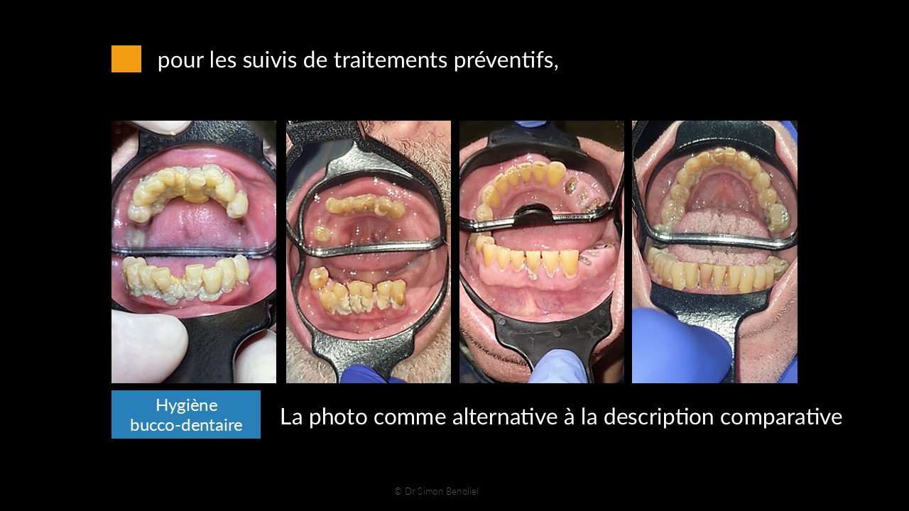 Niveaux d’hygiène bucco-dentaire grâce à l’Odontoscope® Images intraorales prises avec l’Odontoscope montrant des niveaux d’hygiène bucco-dentaire chez des résidents en EHPAD.