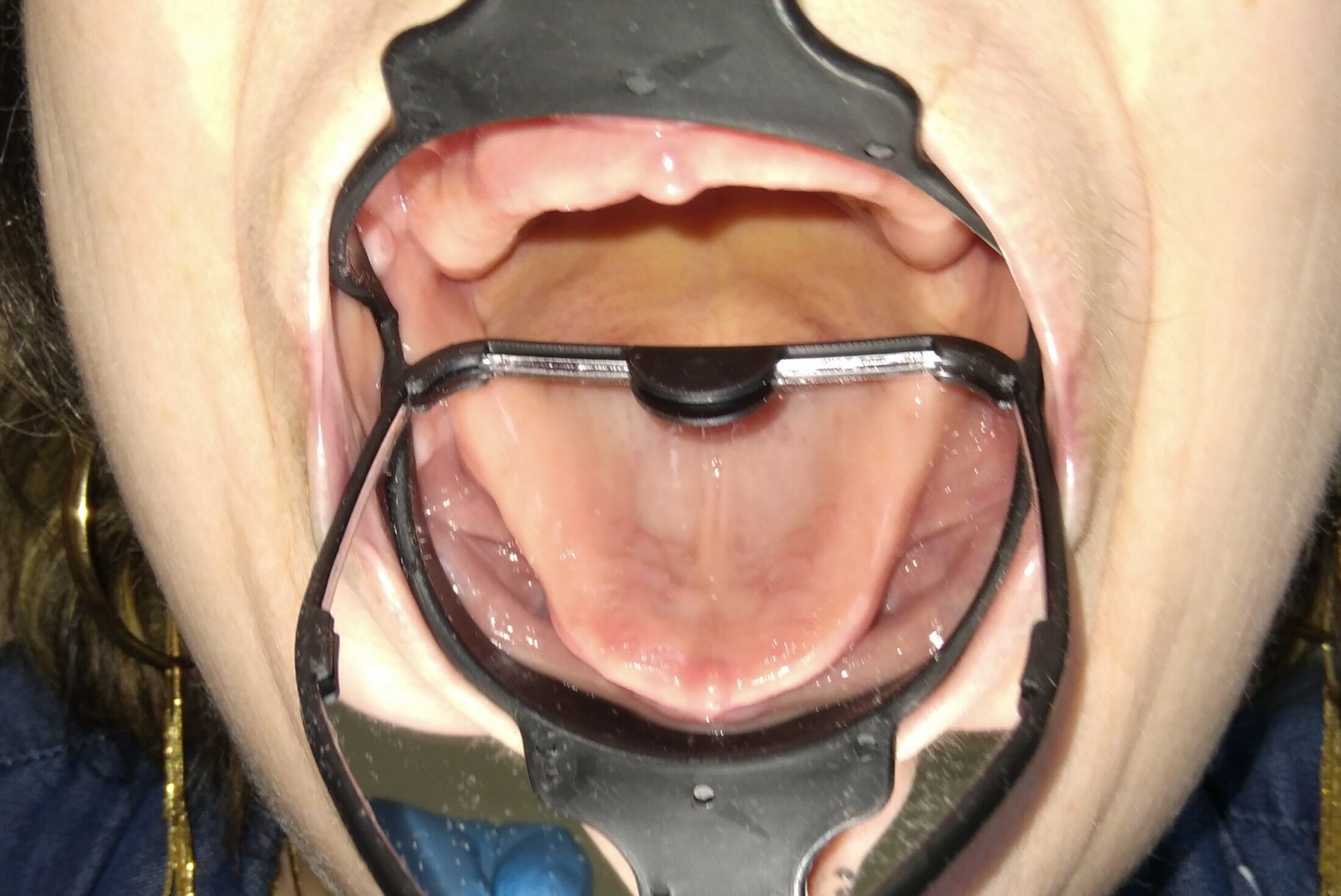 Image intraorale Odontoscope® Vue intraorale élargie de la cavité buccale obtenue avec l’Odontoscope dans un EHPAD. Titre d’image